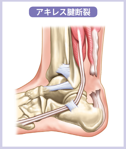 アキレス腱断裂！】手術・リハビリ・完全復帰までの体験記② （再診～入院準備編） | 子煩悩パパの絵本大作戦